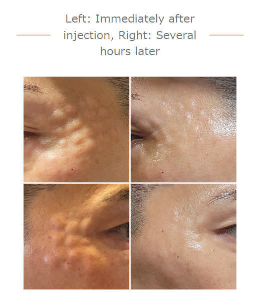 Why do Korean People Inject Salmon Sperm into Their Face?