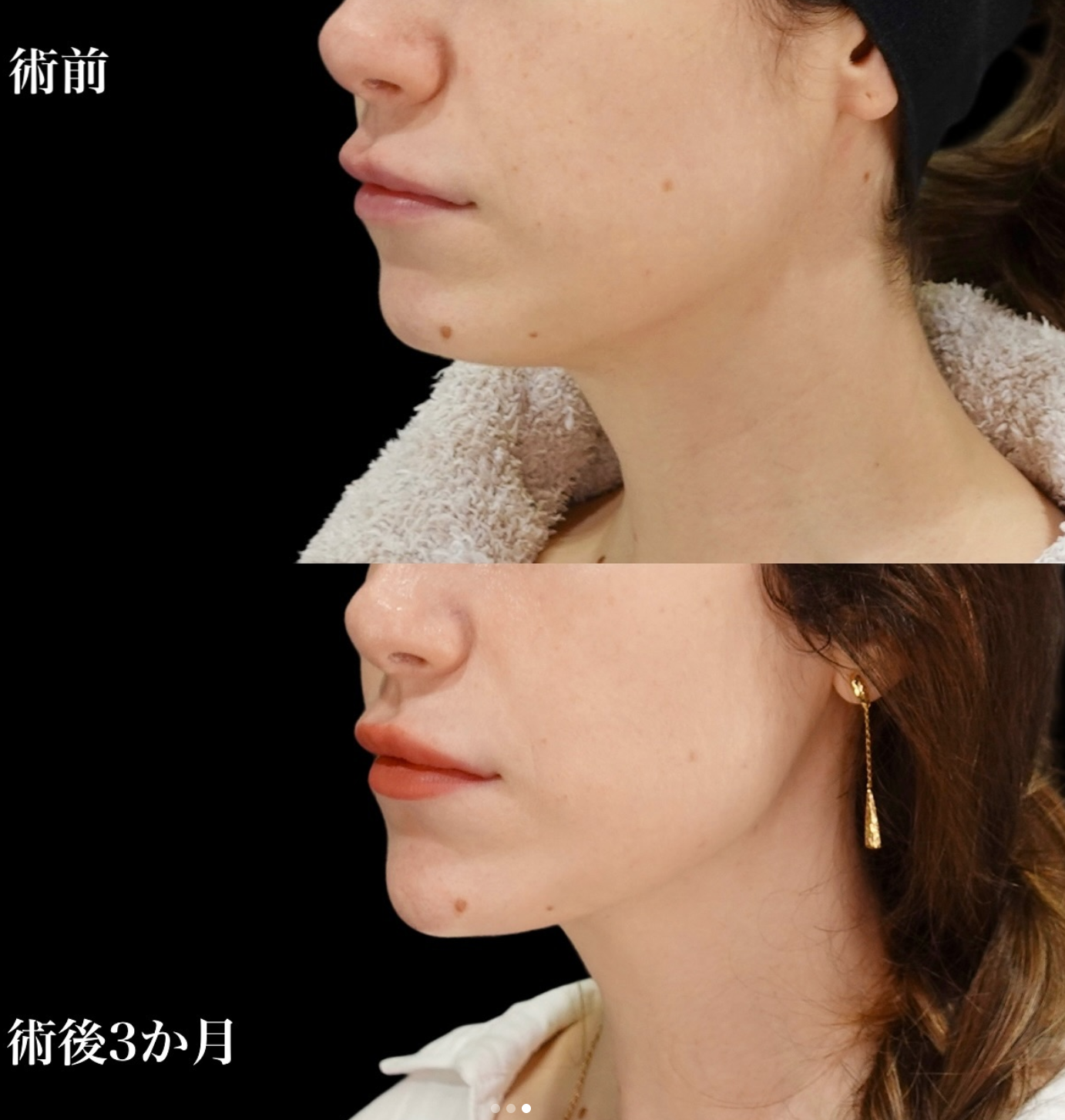 Summer! Top 2 Most Popular Body Treatments