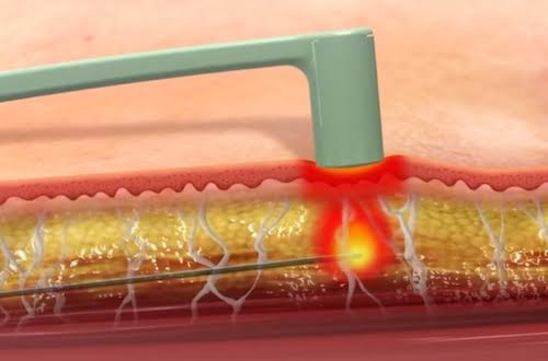 Complete Guide For Sagging Skin. Find the Best Choice.