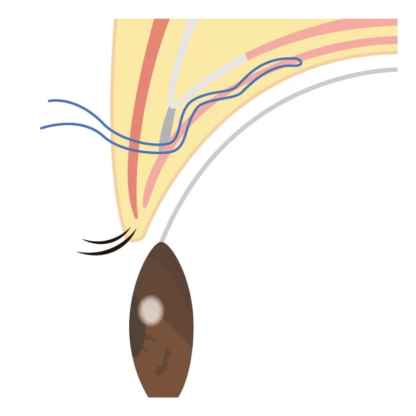 MT Method: non invasive surgery for ptosis.