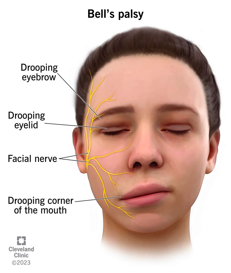 Facial Nerve Paralysis ; causes include face lift.