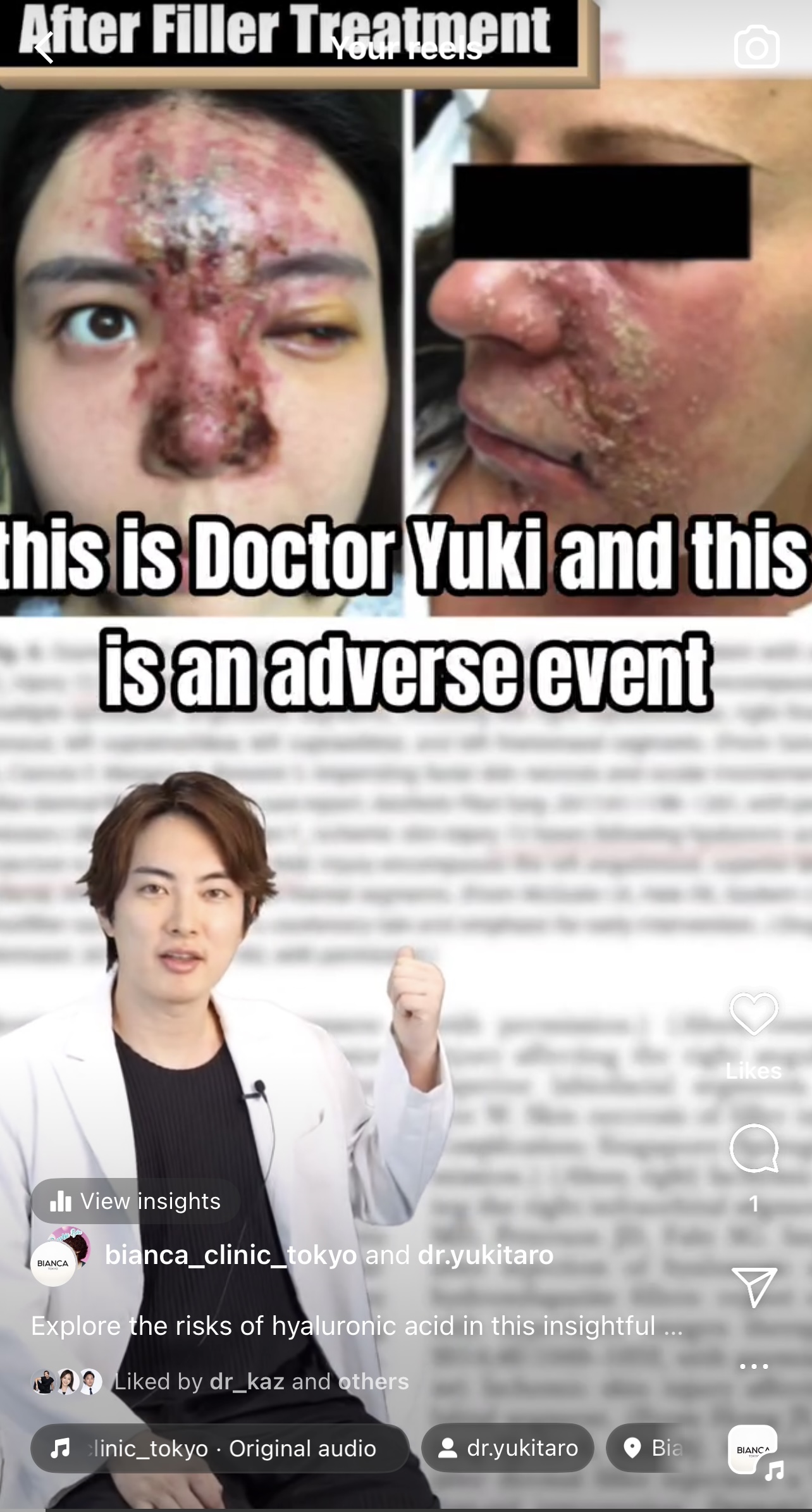 Hyarulonic Acid Complications