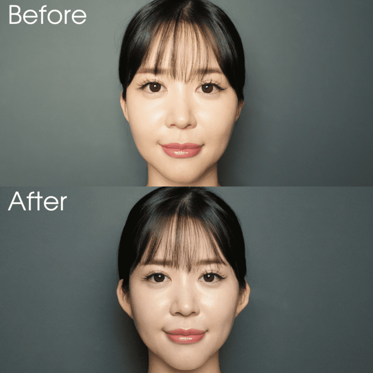 Benefits of Ear Lift with Hyaluronic Acid