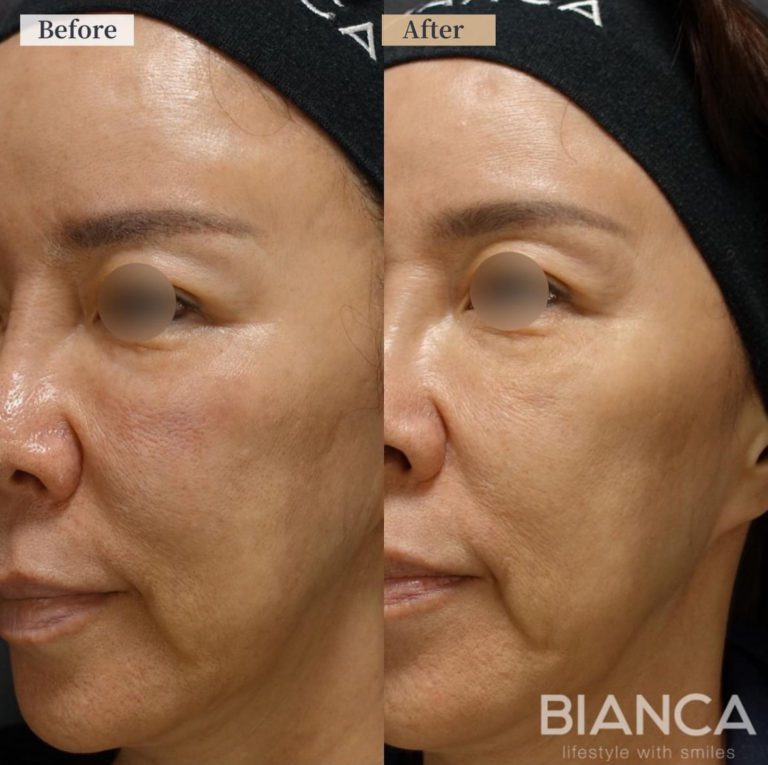 If you’re struggling with pore issues… Try Juvelook!