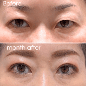 What causes puffy eyes? Solutions based on each cause