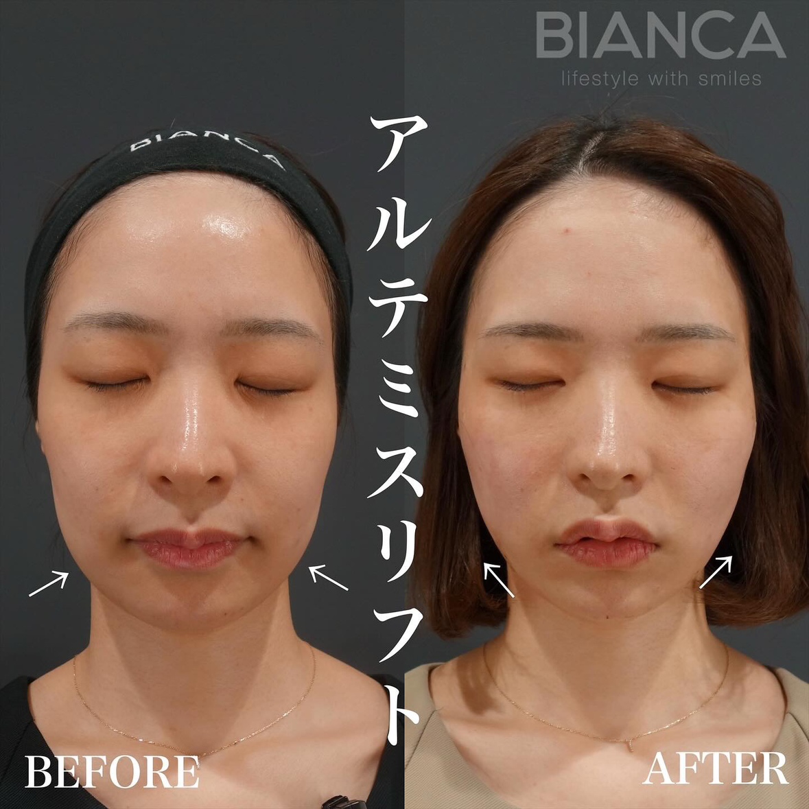 4th Generation Thread Lift ‘Artemis Lift’: Unmatched Lifting Power and Longevity