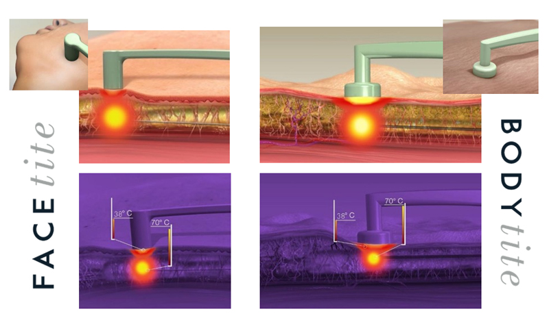 Embrace RF if you’re looking for face line tightening without incisions.