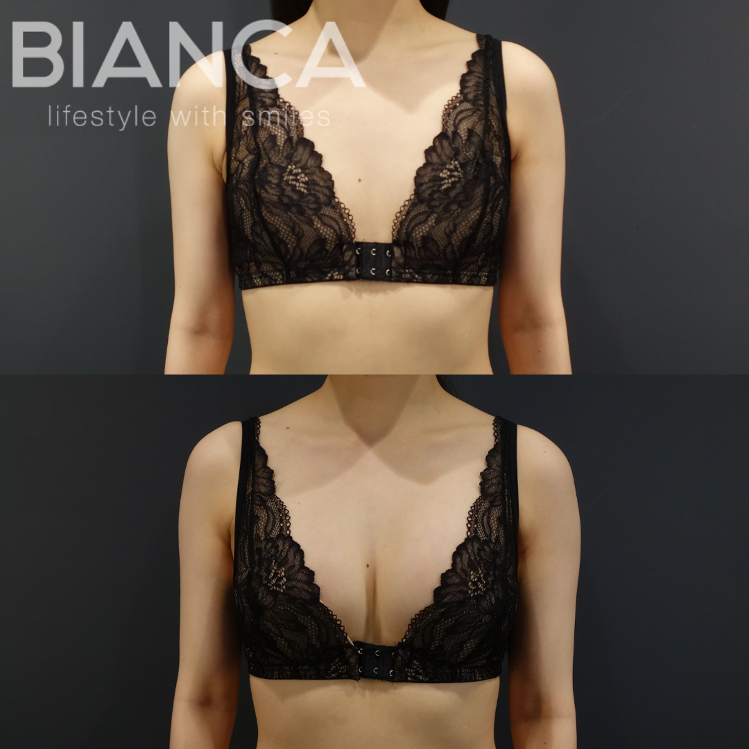 Which breast augmentation is right for me? Silicone implant or fat graft augmentation?