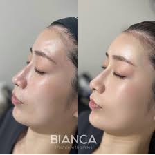 Combat Dry Skin with Injections: All About VOLITE