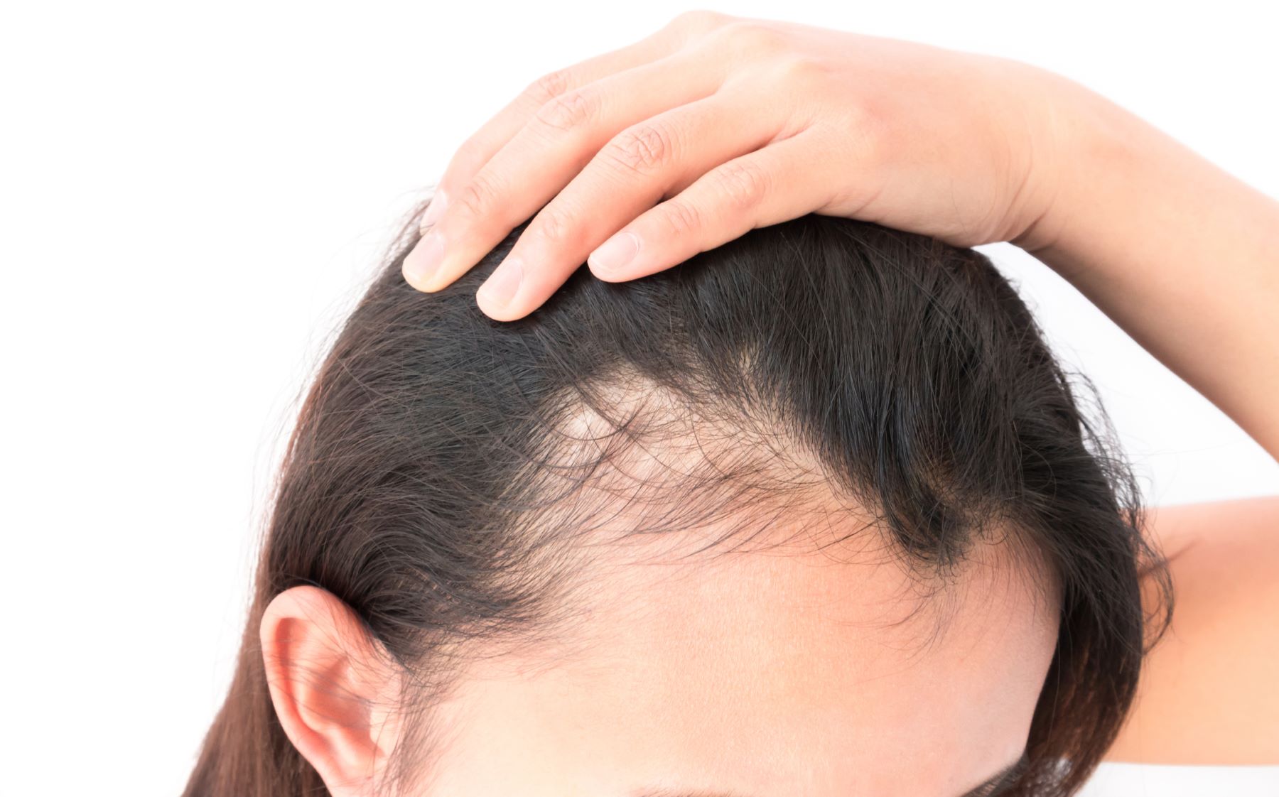 The Connection Between Hormones and Hair Loss: Estrogen’s Role