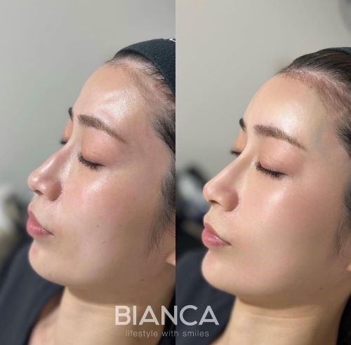 FILLERS