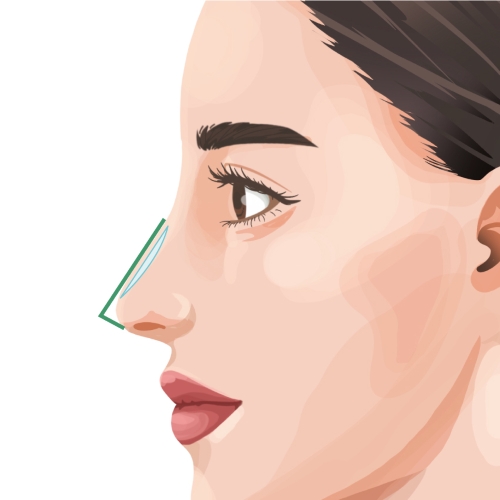 AUGMENTATION RHINOPLASTY