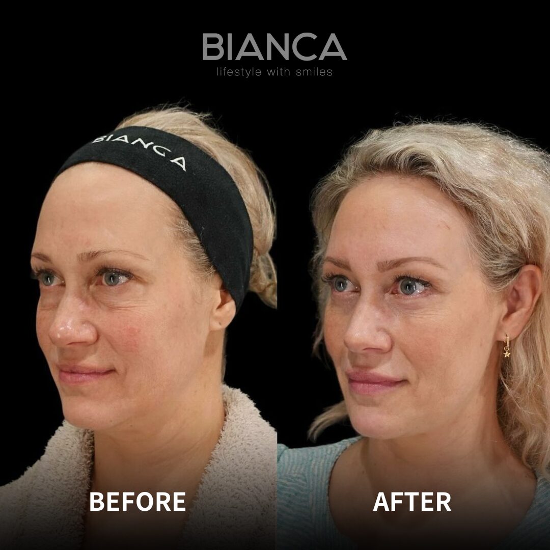 No more tired eyes: Baby Collagen, Transconjunctival Hamra Method and Hamra Method to say goodbye to dark circles.