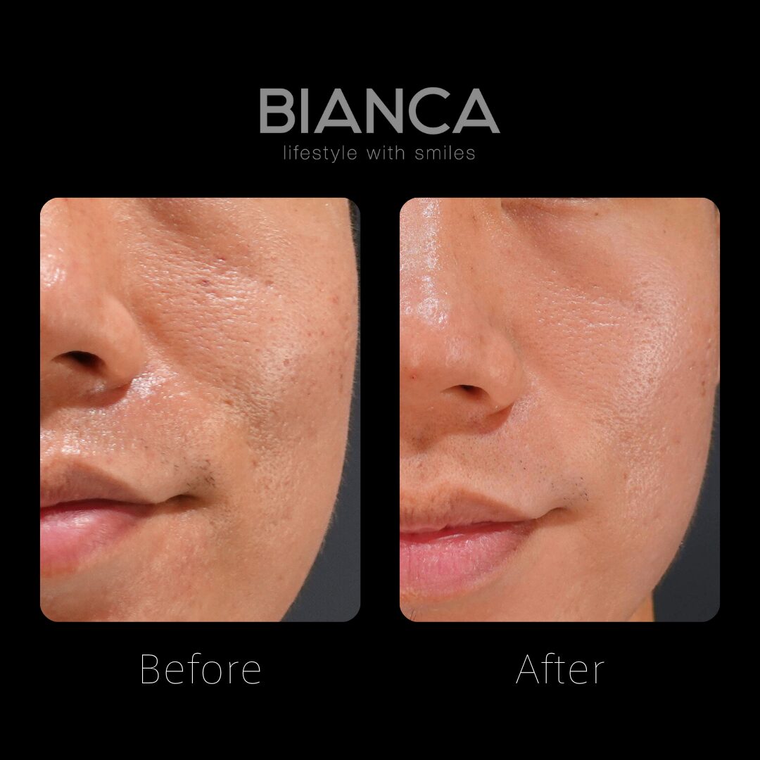 Skin treatments for all skin tones at BIANCA Clinic