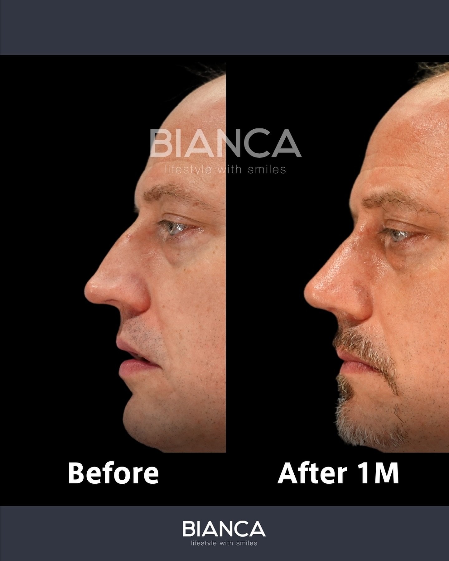 BIANCA RHINOPLASTY