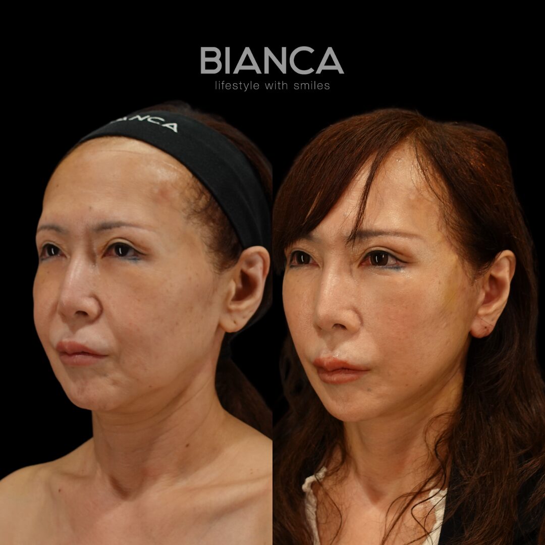 Facelift Before & After: Monitor Patient Highlights