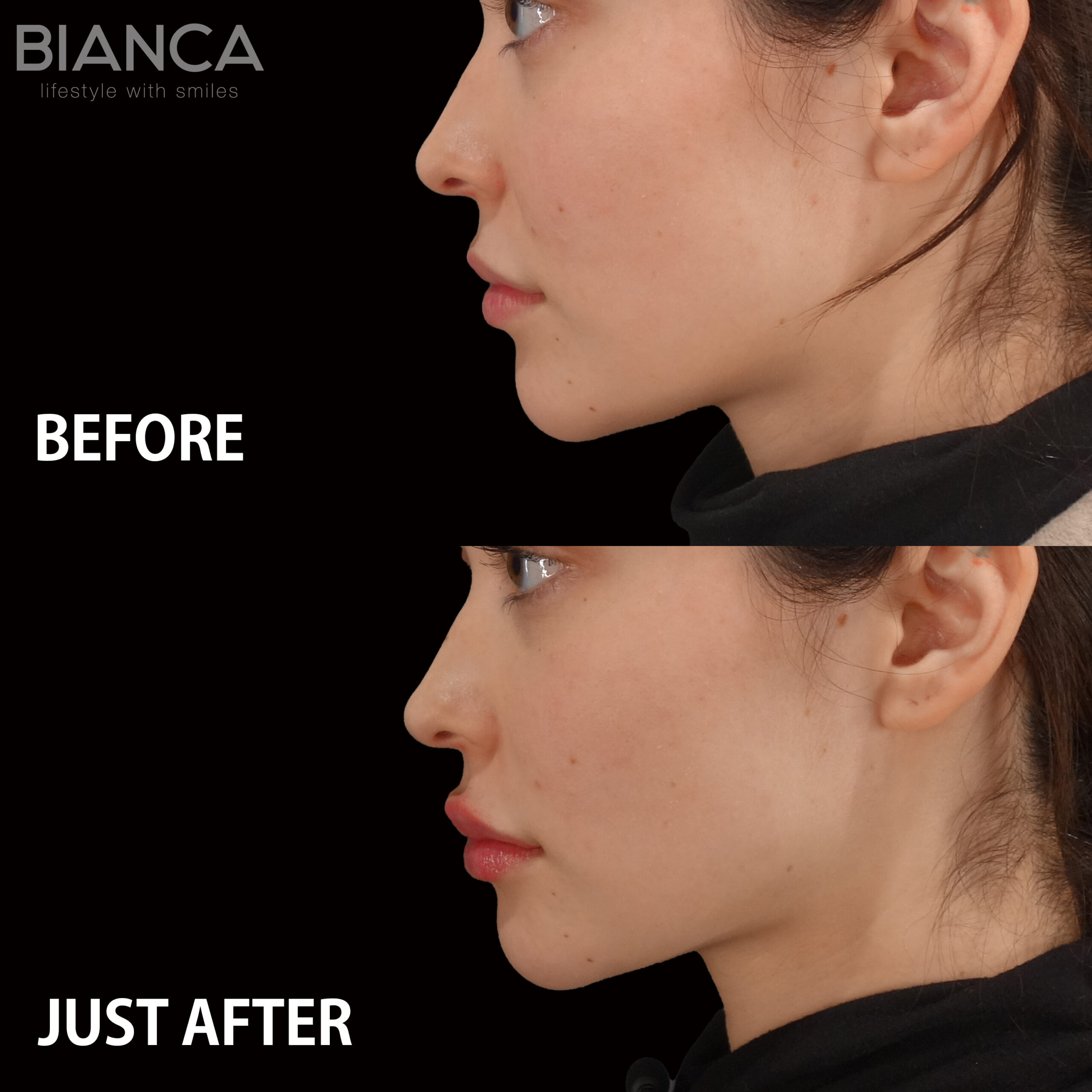 Natural beauty enhancements with injectables: Real case highlights