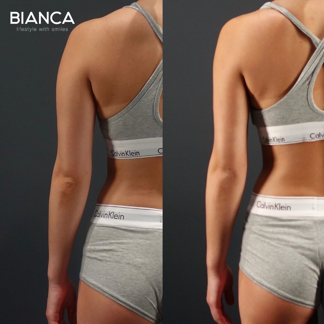 What is VASER Liposuction?