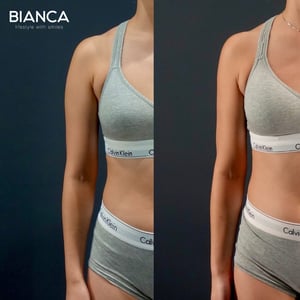 VASER Liposuction Plastic Surgery