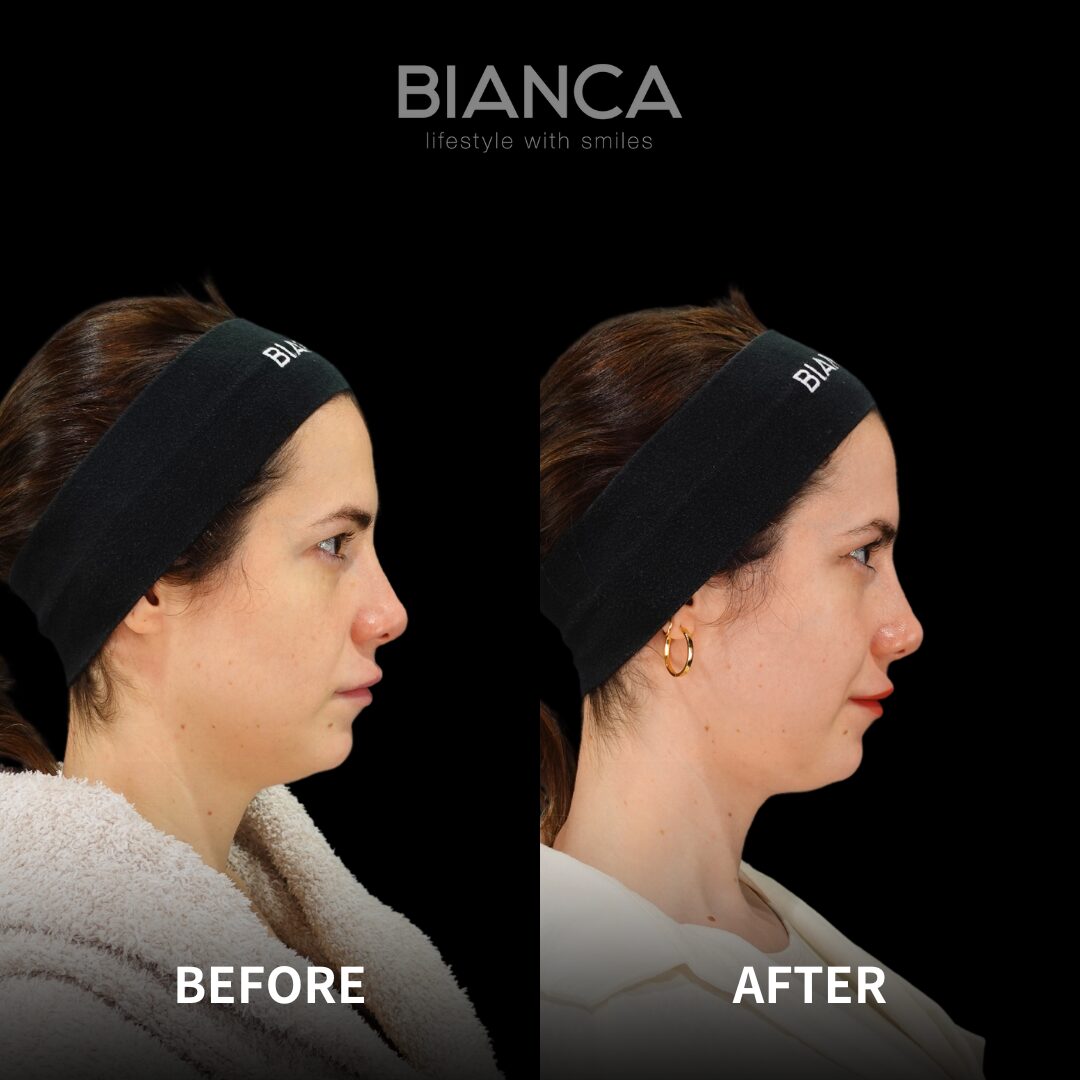 Discover Embrace RF: the non-surgical solution for facial contouring and skin tightening