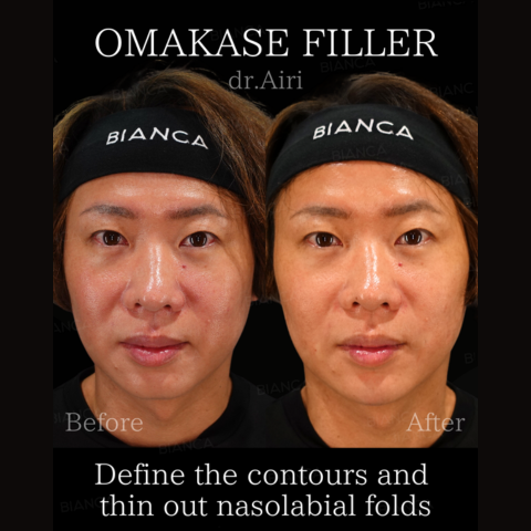 Nasolabial fold filler: A thorough explanation of effects, duration, and downtime.
