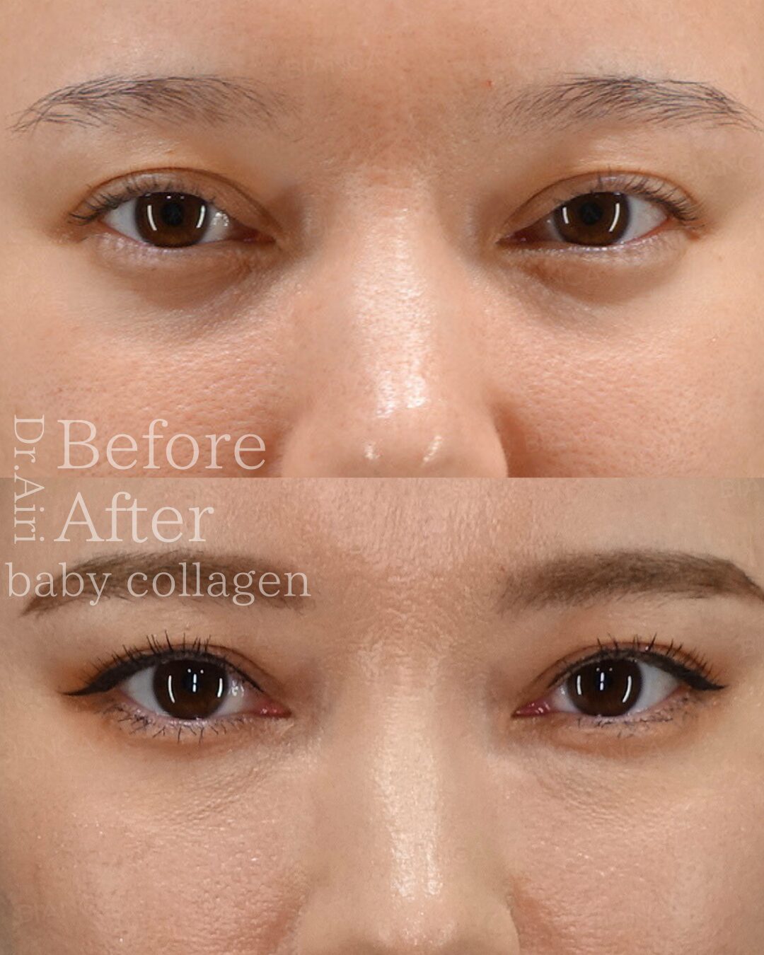 Baby Collagen Injection, the perfect treatment for dark circles and fine wrinkles under the eyes