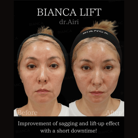 Thread lift: lift your face line with minimal downtime