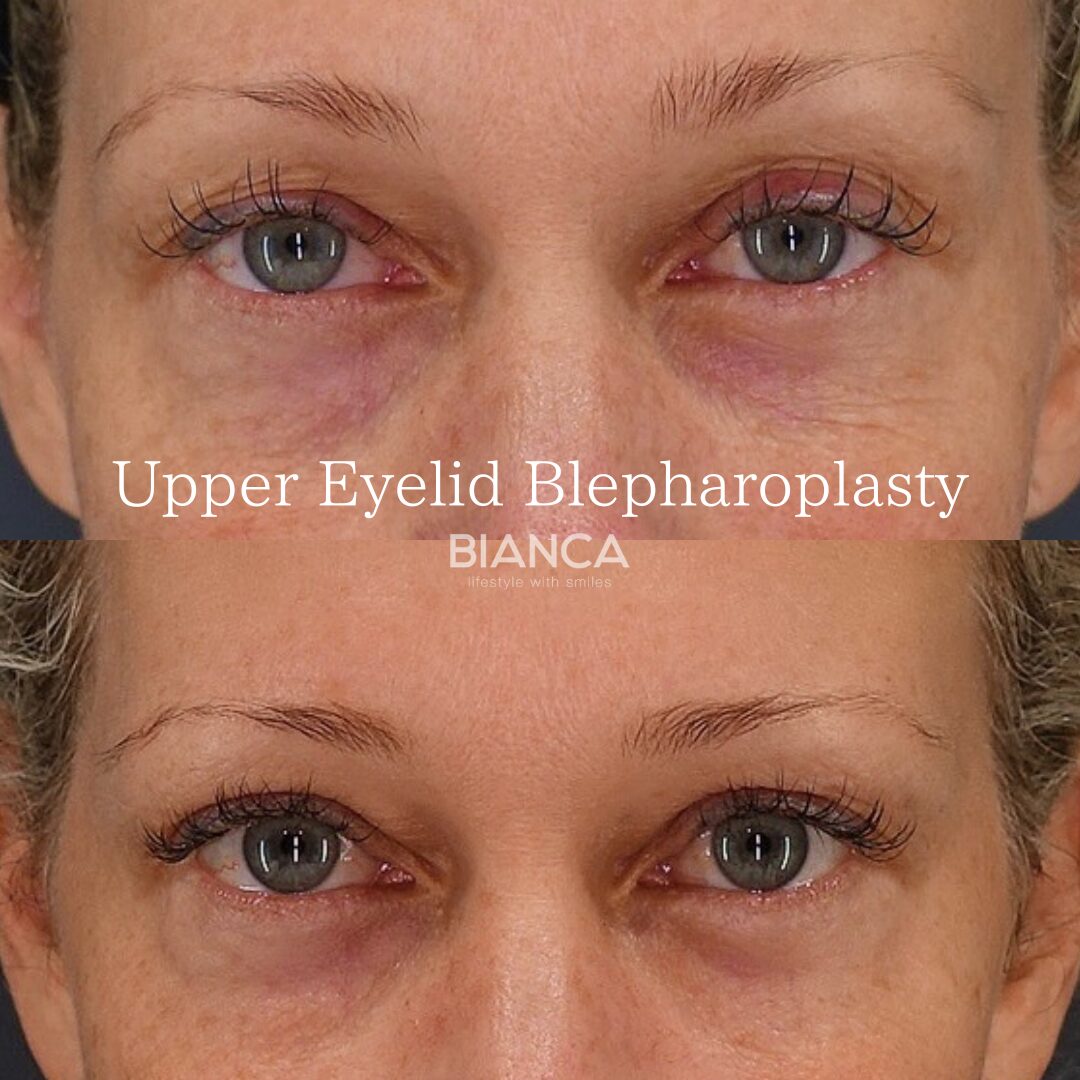 Say Goodbye to Puffy Eyes: Upper Eyelid Fat Removal Explained
