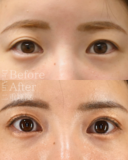 “I want double eyelids, but I’m worried about the progress after the surgery …”