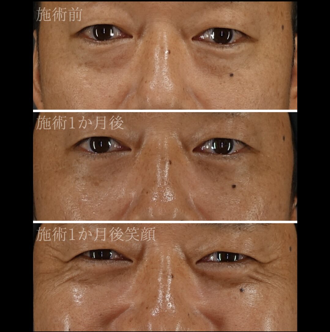 Ultimate rejuvenation: Transconjunctival Blepharoplasty (under eyes dark circles removal) explained