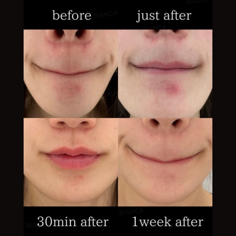 ADVATx Laser or better “party laser” explained