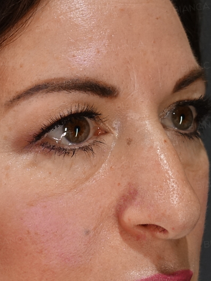 45-degree View After