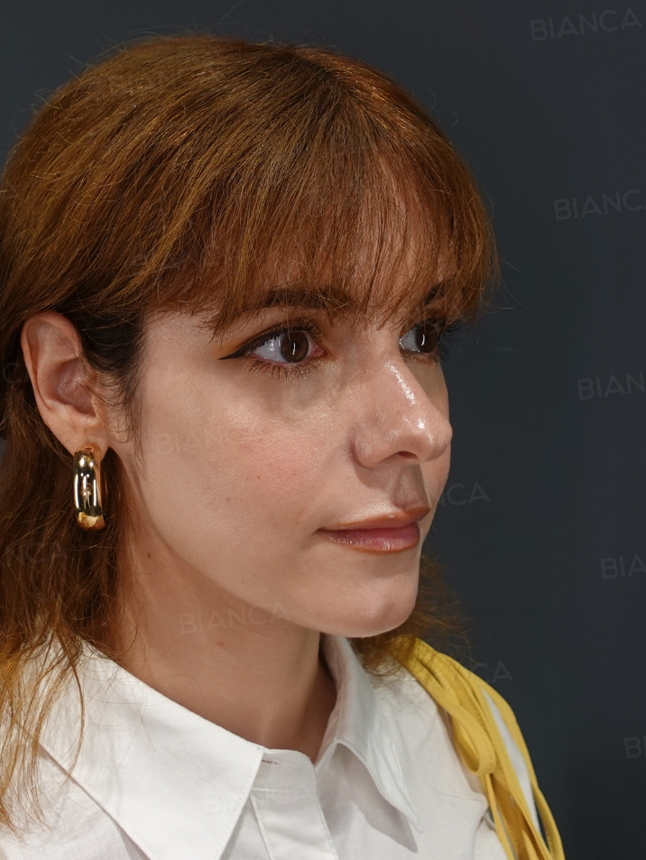 45-degree View After