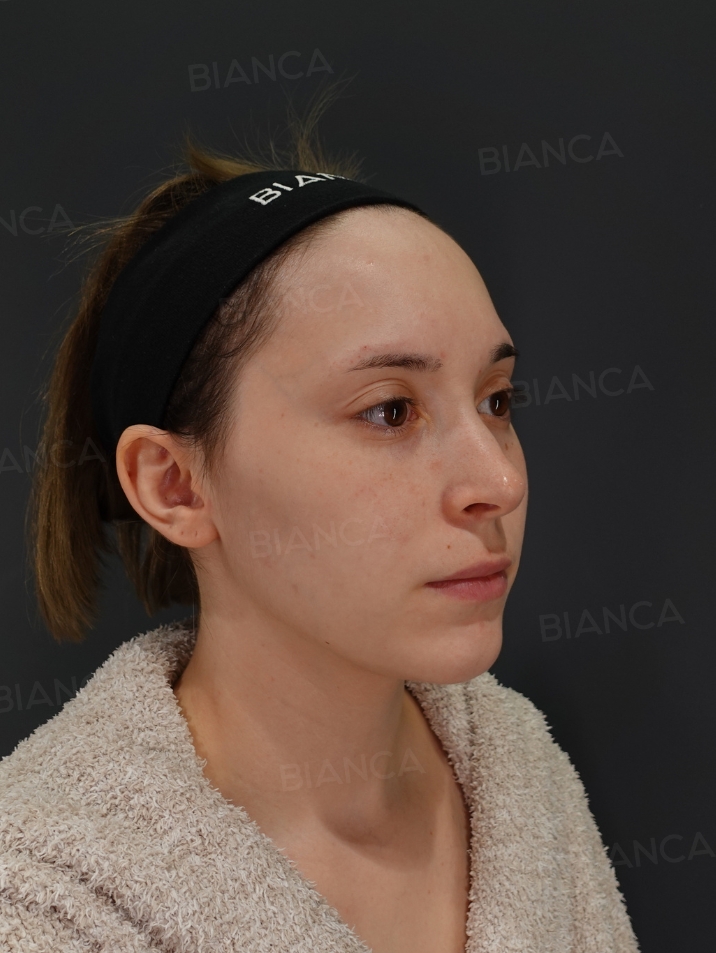 45-degree View Before