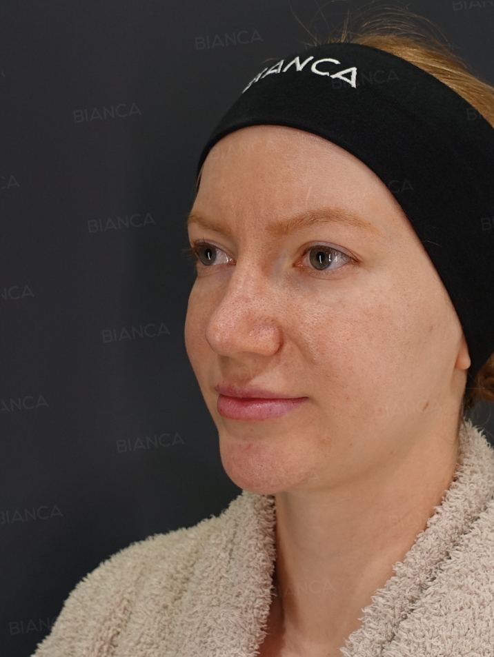 45-degree View Before