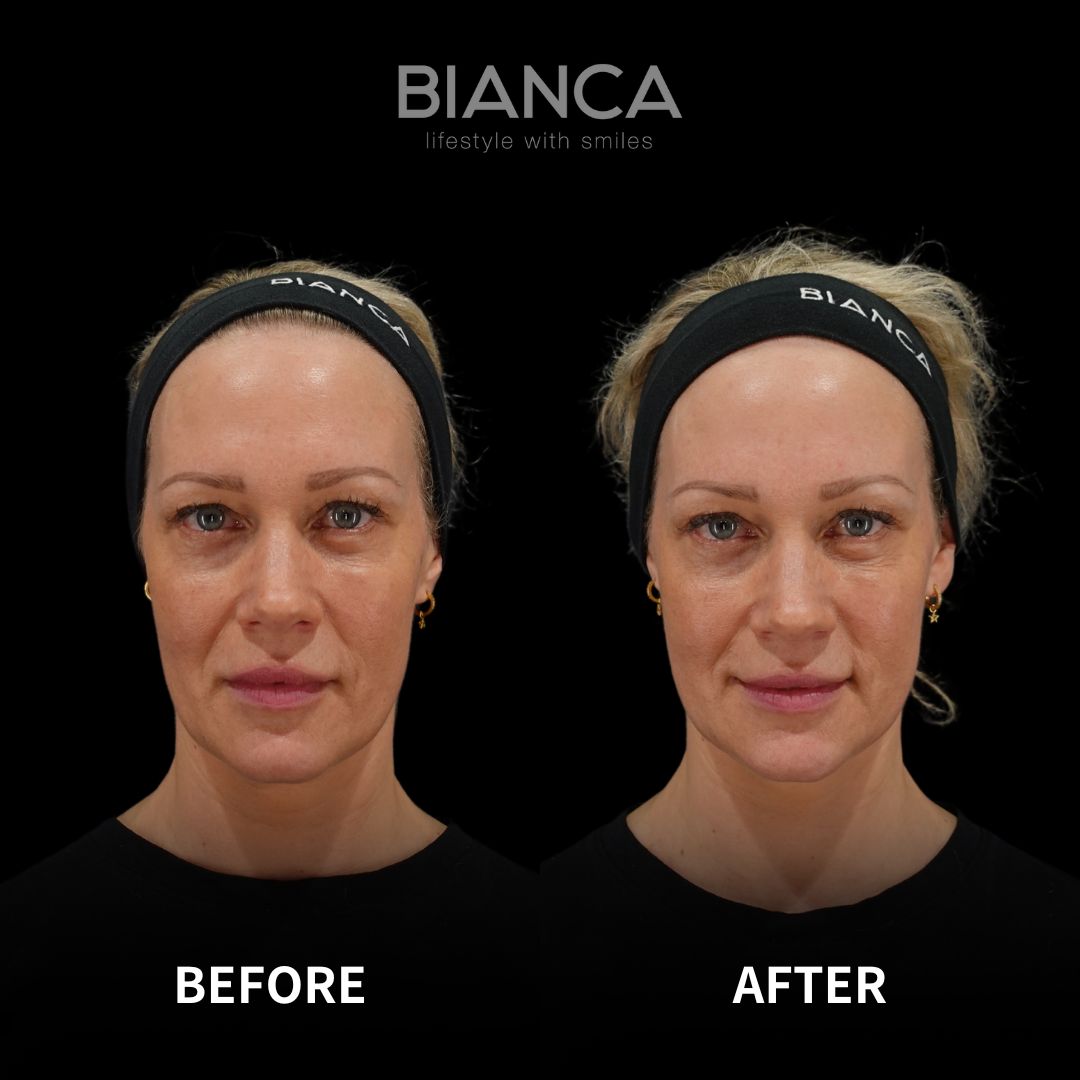 What’s is HArmonyCa?