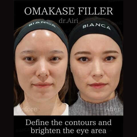TFT (Total Facial Treatment) Hyaluronic Acid Treatment : OMAKASE FILLER
