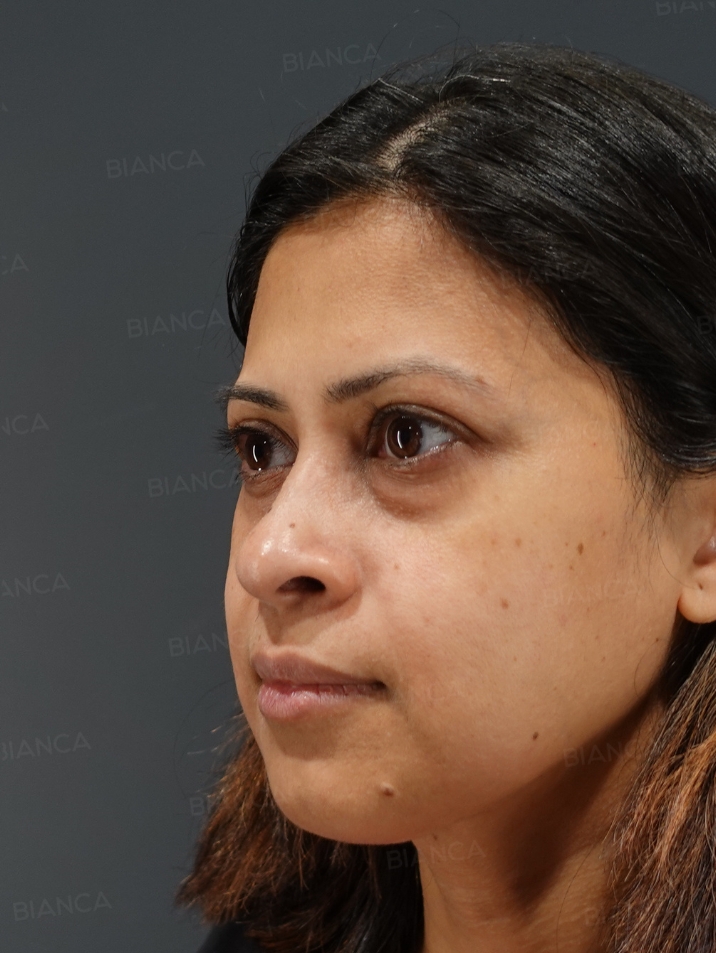 45-degree View Before