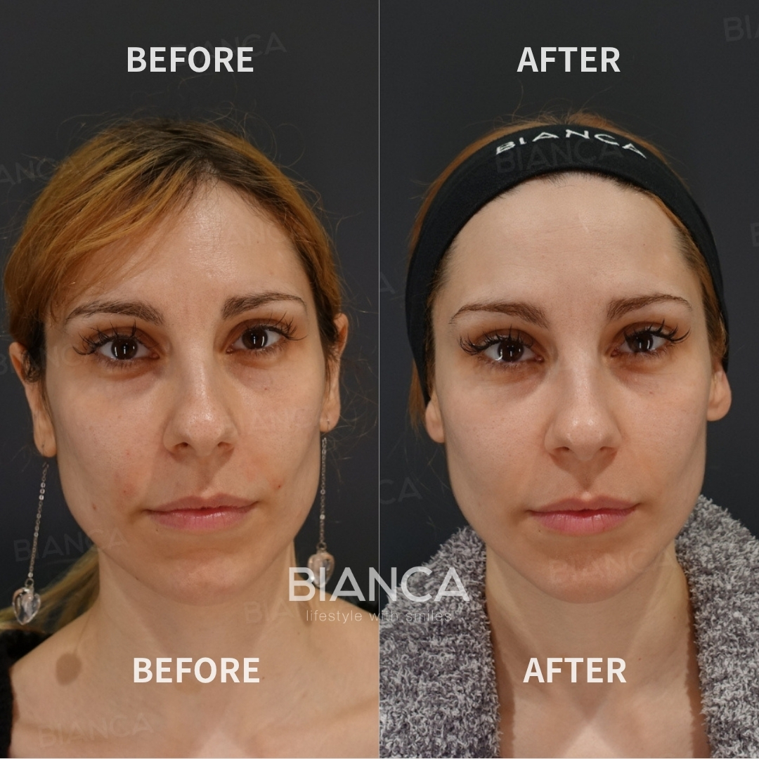 Hyaluronic Acid Injection For Nasolabial Folds