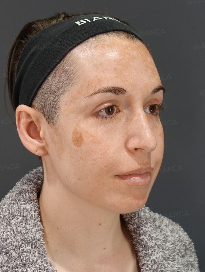 45-degree View Before