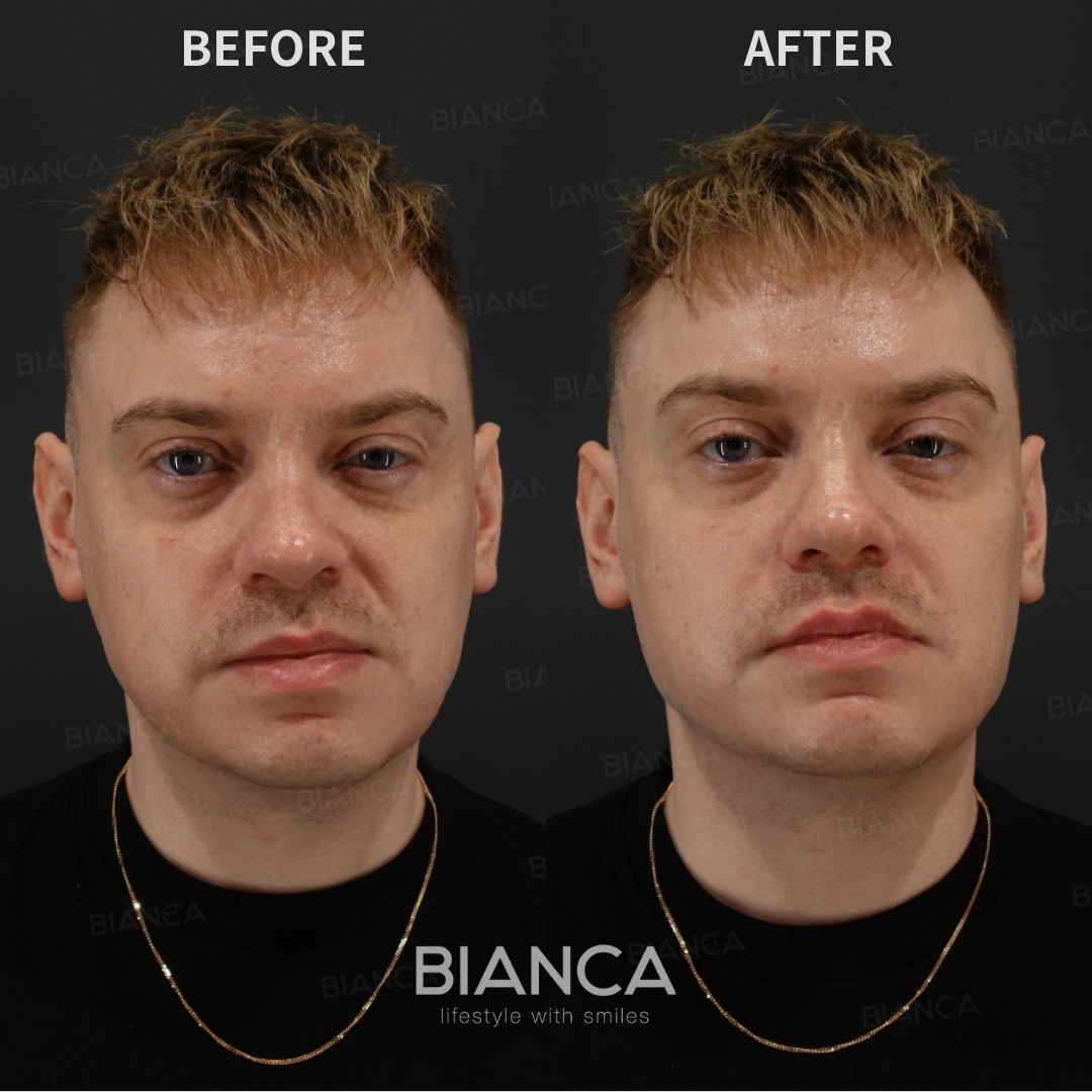 Hyaluronic Acid Injection For Lips and Jaw Line