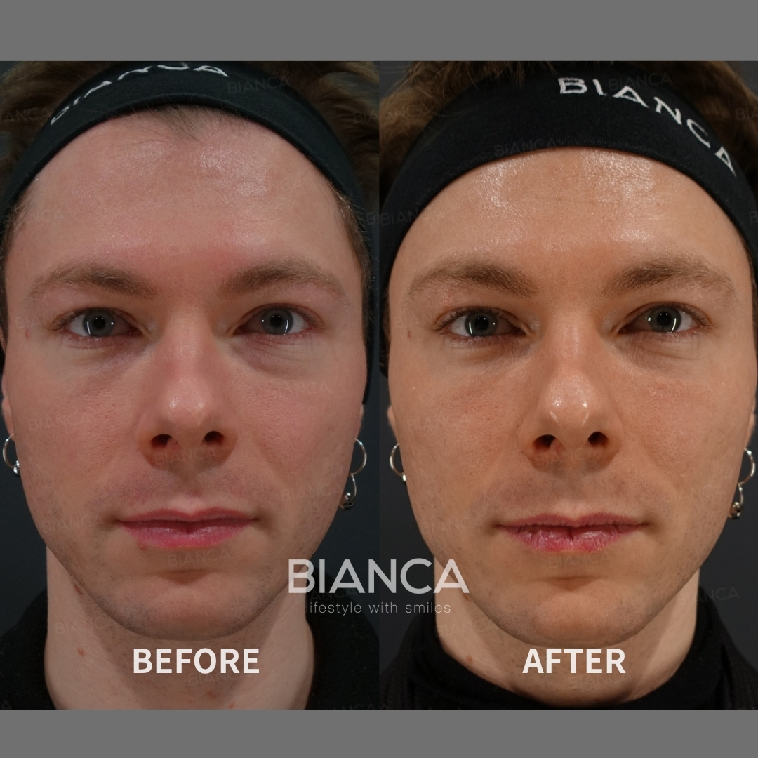 Juvelook Injection For Full Face