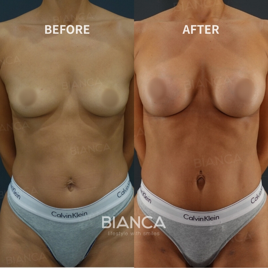 Hybrid Breast Augmentation (silicon implant + CRF)