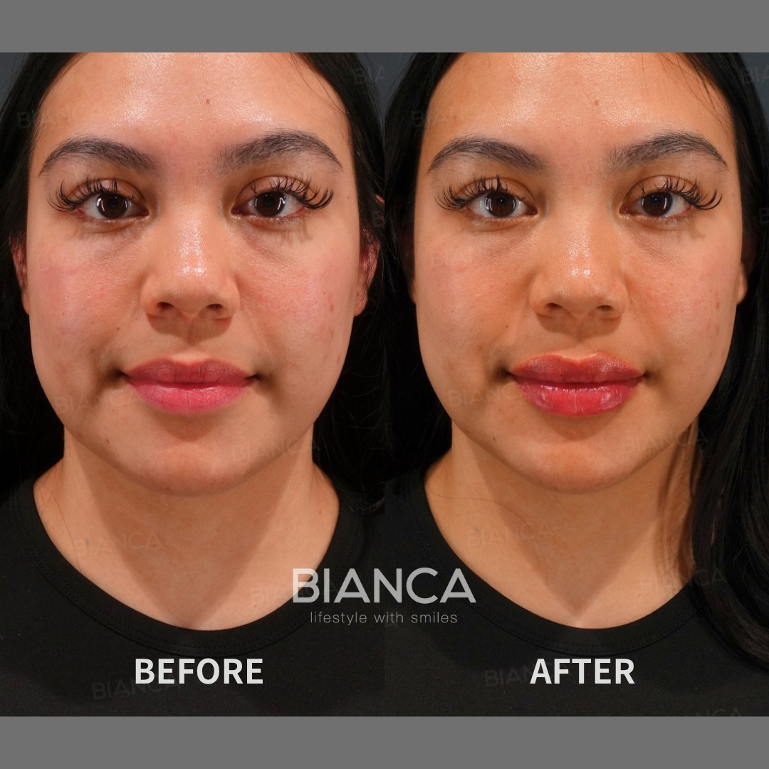 Hyaluronic Acid Injection For Lips