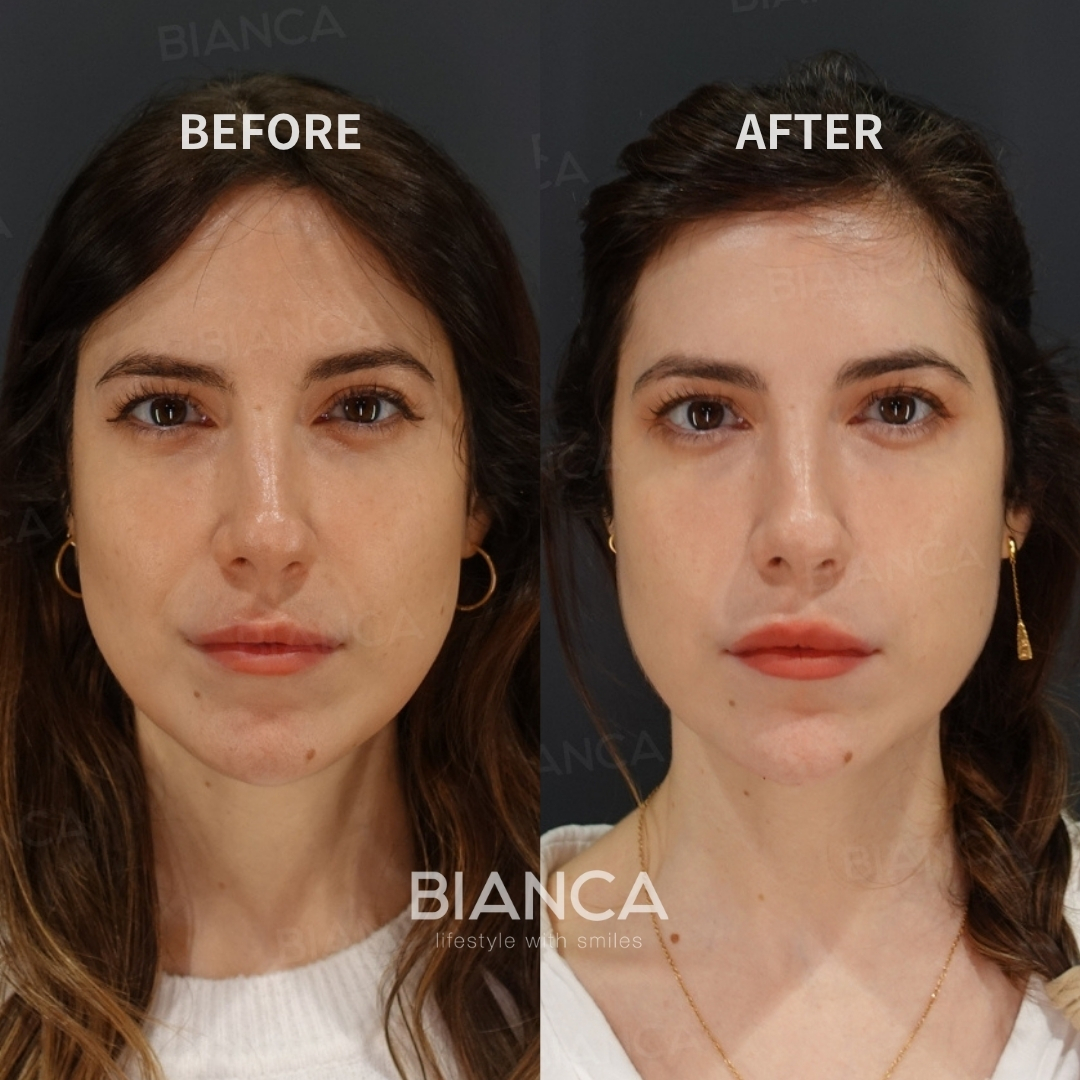 Hyaluronic Acid Injection For Chin