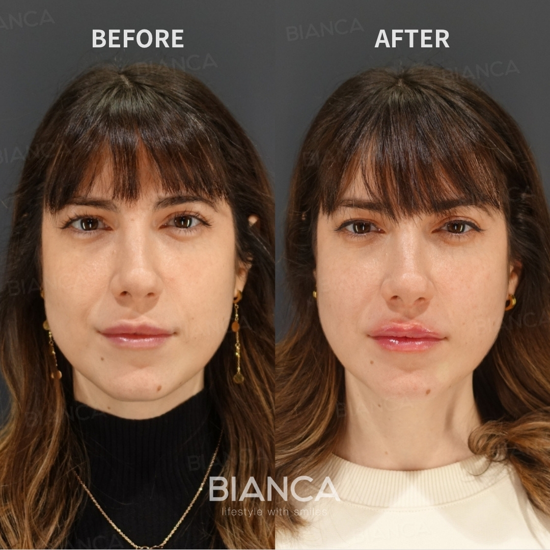 Hyaluronic Acid Injection For Lips