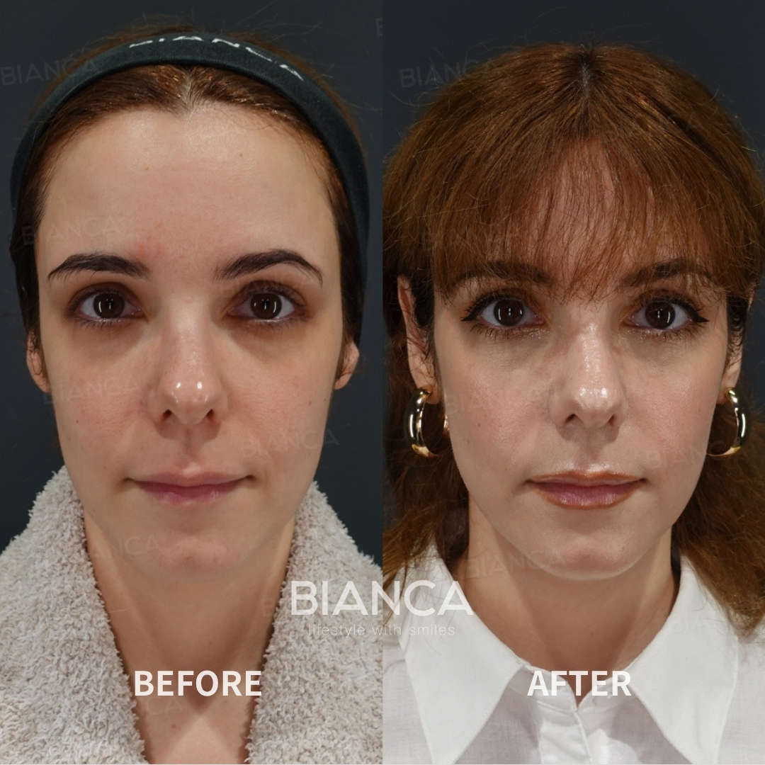 Hyaluronic Acid Injection For Lips