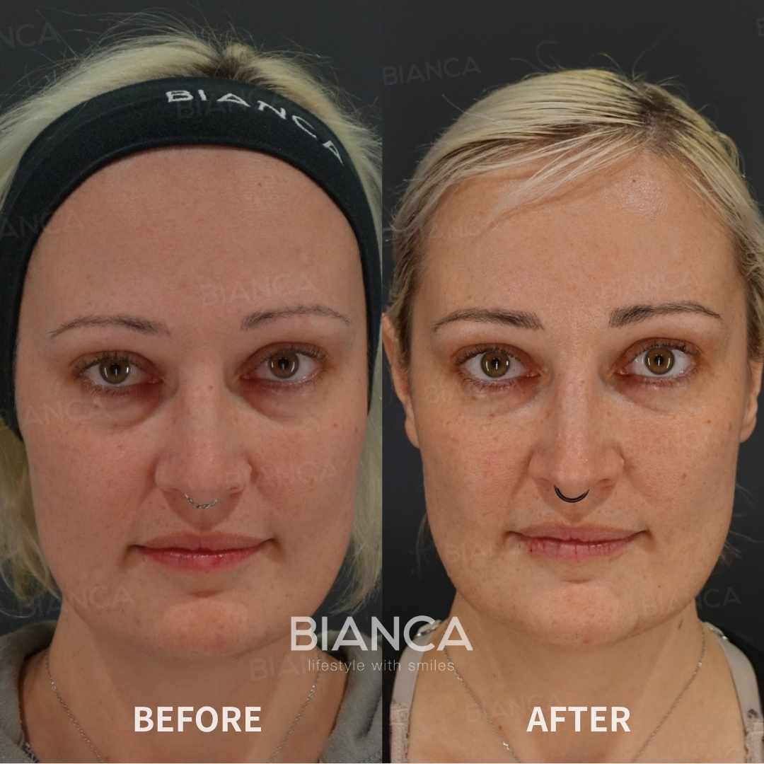 Hyaluronic Acid Injection For Under Eyes