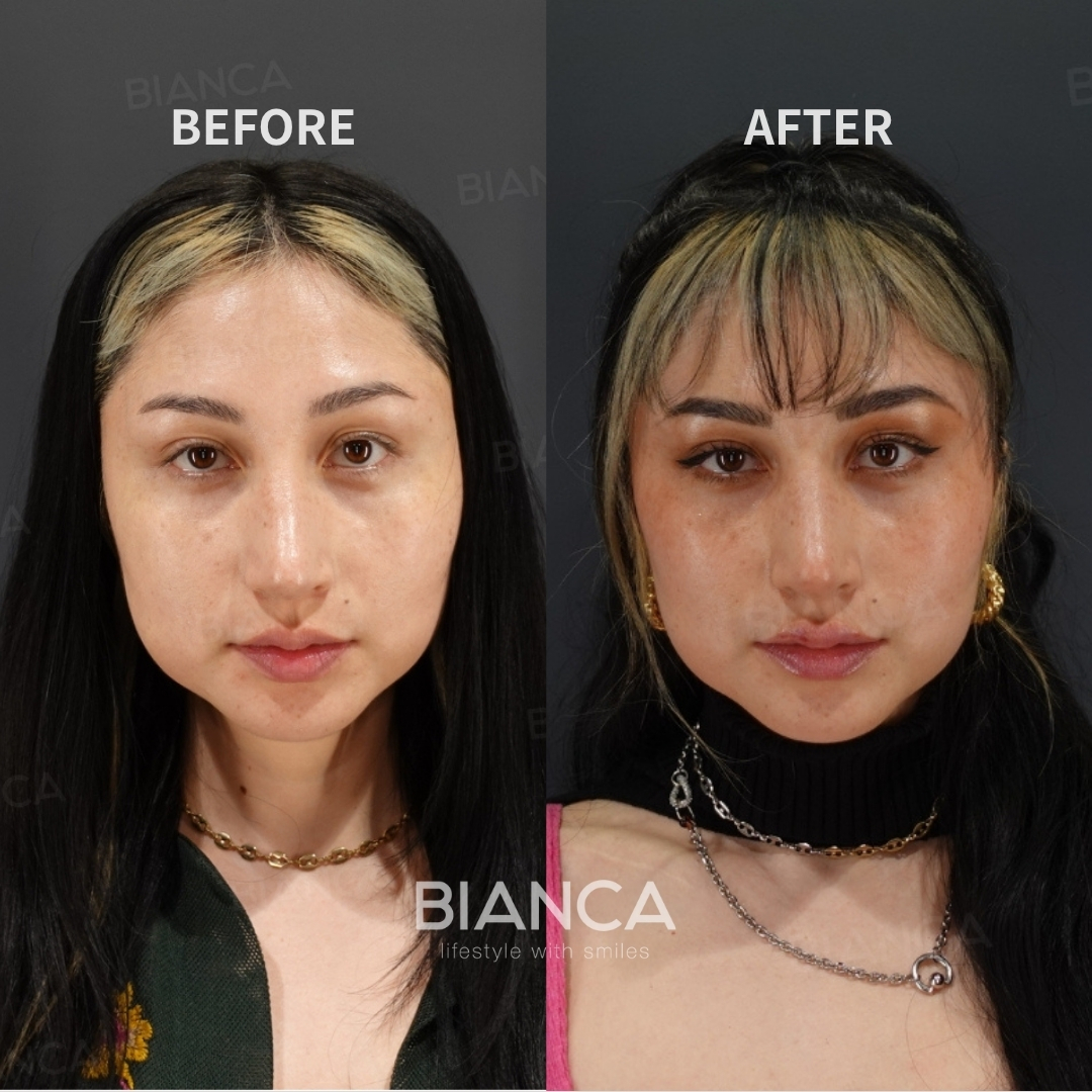 Rejuran for Whole Face