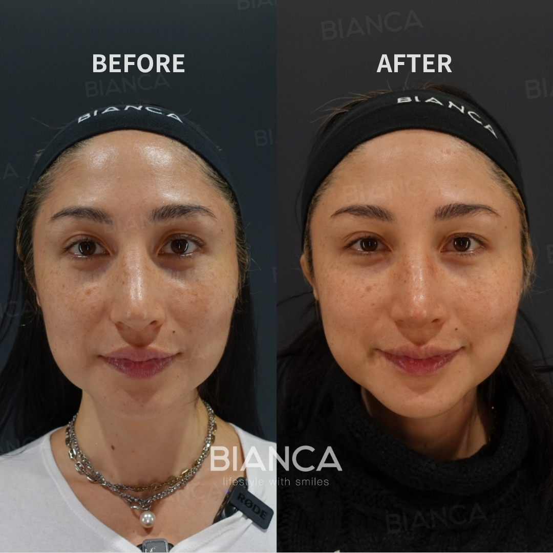 Juvelook Volume（Lenisna）For Under-Eye and Nasolabial Folds